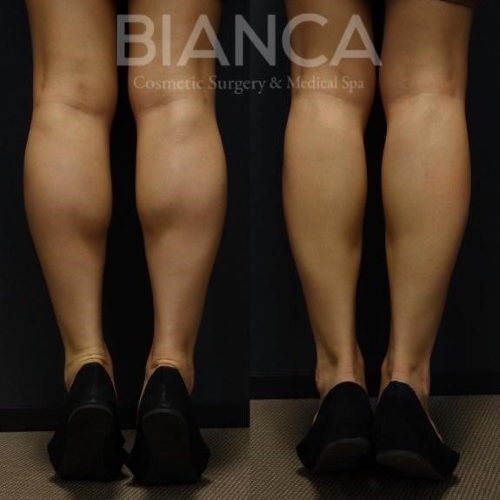 ふくらはぎボトックス_症例_ビアンカクリニック